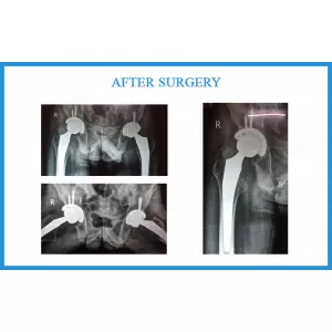 Gopal Maliwal Ankylosing Spondylitis