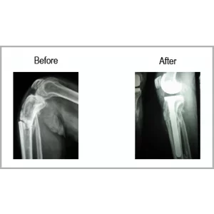 Old Fracture Of Spin Bone With Osteoarthritis