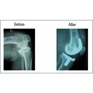 Old Fracture Of Spin Bone With Osteoarthritis