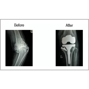 Osteoarthritis With Large Bony Defect