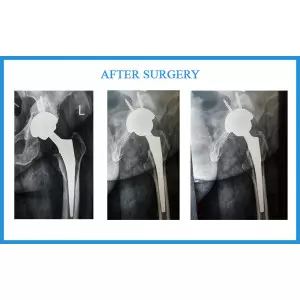 Paliwal Santoshben - After Acetabulum Fracture