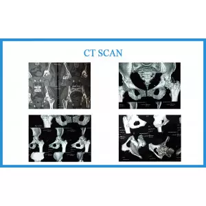 Paliwal Santoshben - After Acetabulum Fracture