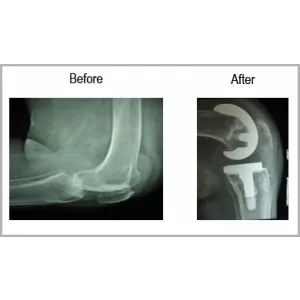 Rheumatoid Arthritis (RA)