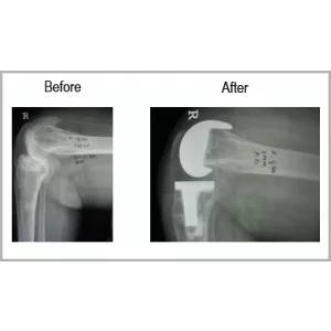 Rheumatoid Arthritis (RA) With Old United Fracture Femur