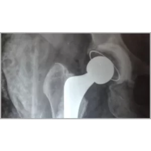 Right Total Hip Replacement And Right Total Knee Replacement In Single Stage Only