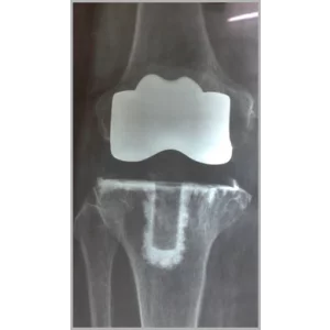 Right Total Hip Replacement And Right Total Knee Replacement In Single Stage Only