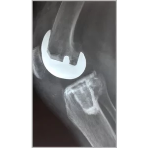 Right Total Hip Replacement And Right Total Knee Replacement In Single Stage Only