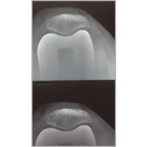 Right Total Hip Replacement And Right Total Knee Replacement In Single Stage Only