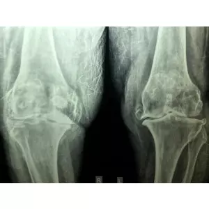 Single Sitting Total Hip And Knee Replacement F/75 Obese