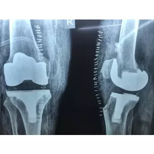 Single Sitting Total Hip And Knee Replacement F/75 Obese