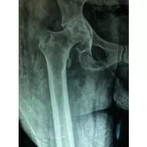 Single Sitting Total Hip And Knee Replacement F/75 Obese