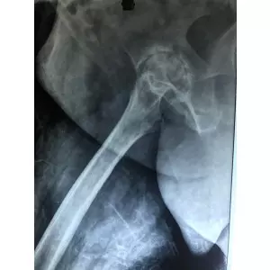 Single Sitting Total Hip And Knee Replacement F/75 Obese