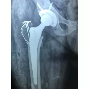 Single Sitting Total Hip And Knee Replacement F/75 Obese