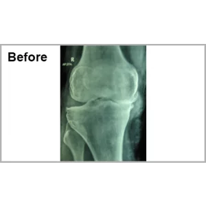 Spine Surgery And Knee Replacment Both
