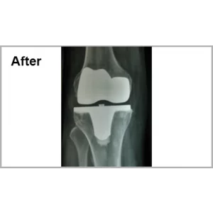 Spine Surgery And Knee Replacment Both
