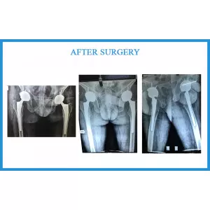 Vishan Mali - Ankylosing Spondylitis