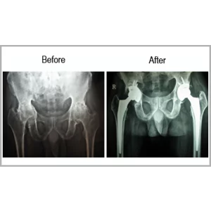 Ankylosing Spondylitis Thaltej