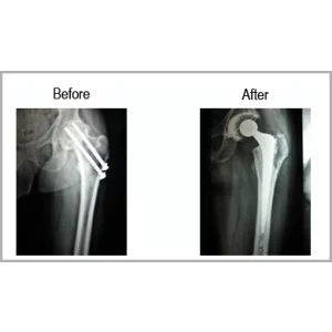 AVN After Neck Femur Fracture Vastral