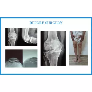 Best Joint Replacement Surgeon In Saraspur