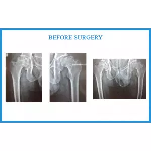 Best Joint Replacement Surgeon In Vatva