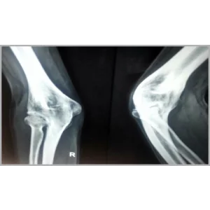 Orthopedic Surgeon Performing Elbow Surgery
