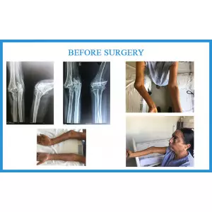 Elbow Surgery Vatva