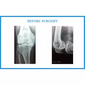 Experienced Joint Replacement Surgeon In Amraiwadi