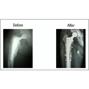 Orthopedic Surgeon Performing Joint Replacement Surgery In A Clinical Setting