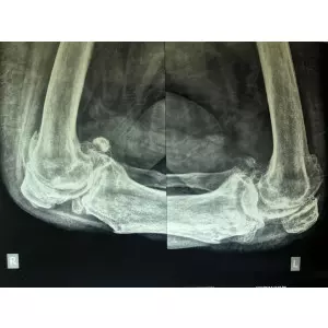 Orthopedic Surgeon Performing Knee Replacement Surgery Showing Precision Tools