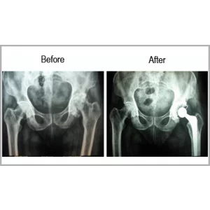 Top Joint Replacement Surgeon In Ahmedabad
