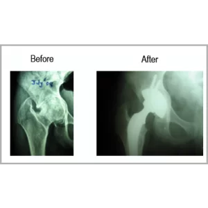 Top Joint Replacement Surgeon In Bodakdev