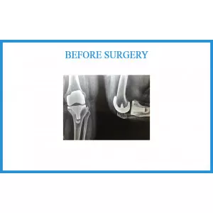 Top Joint Replacement Surgeon In Sarkej