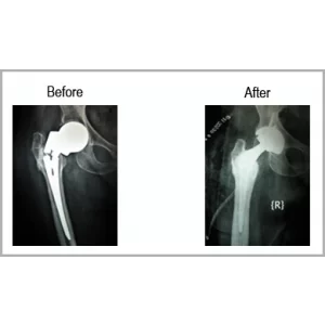 Top Joint Replacement Surgeon Juhapura