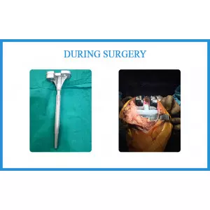 Top Knee Replacement Surgeon In Chandkheda