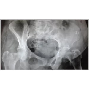 Orthopaedic Surgeon Performing Total Joint Replacement Surgery