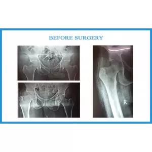 Whole Knee Replacement Surgeon In Vastral